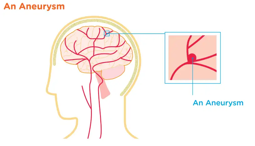 Aneurysm diagram