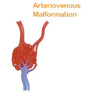 Arteriovenous malformation diagram