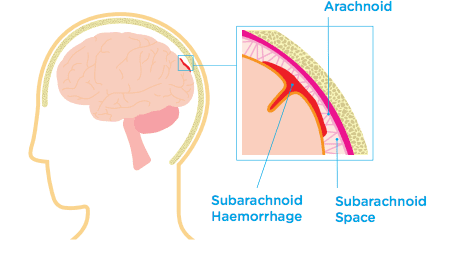 subarachnoid haemorrhage diagram