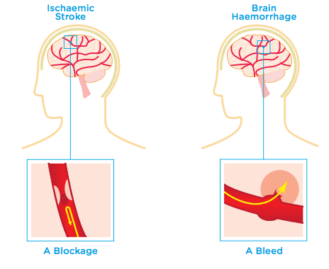 stroke and haemorrhage diagram