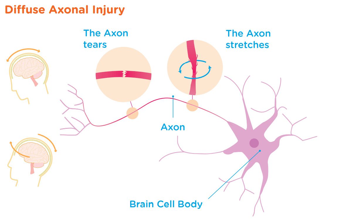 Diffuse Axonal Injury Diagram